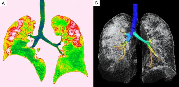 image 2 Coronavirus Chest Xray2