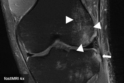 resonancias magneticas Facebook desarolla una inteligencia artificial que hace las resonancias magnéticas 4 veces más rápido resonancias magnéticas más rápidas