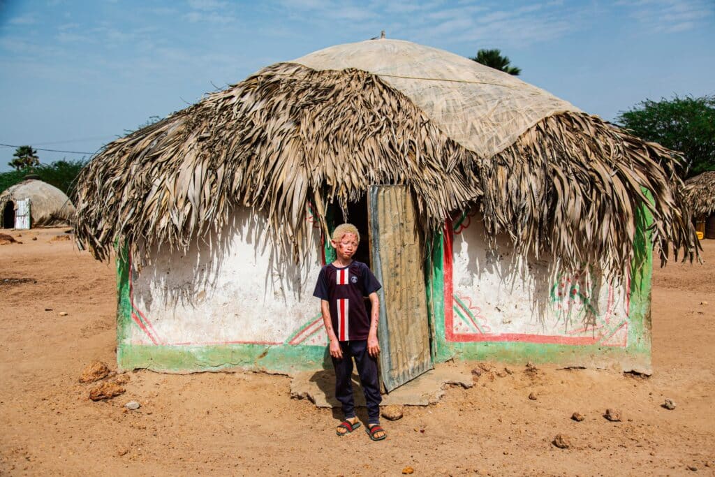 image Proyecto Melanina Albinismo en Africa Una fotografa espanola comparte un emocionante registro documental con Proyecto Melanina 7