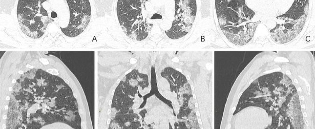 0_Coronavirus-Chest-Xray